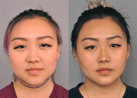 buccal fat removal 10 years later|The Long